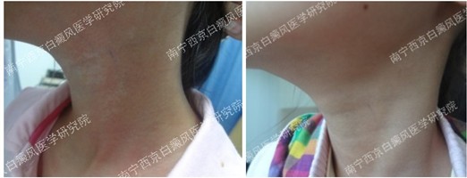 9岁女孩颈部白癜风治疗一月
